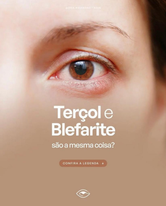 Tratamento de Blefarite ou Terçol em Curitiba